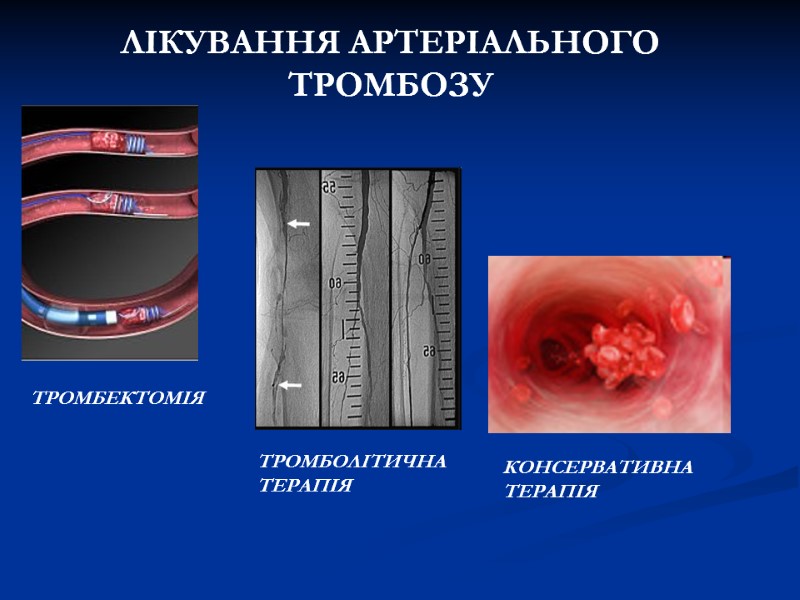 ЛІКУВАННЯ АРТЕРІАЛЬНОГО ТРОМБОЗУ ТРОМБОЛІТИЧНА ТЕРАПІЯ ТРОМБЕКТОМІЯ КОНСЕРВАТИВНА ТЕРАПІЯ ЛІКУВАННЯ АРТЕРІАЛЬНОГО ТРОМБОЗУ ТРОМБОЛІТИЧНА ТЕРАПІЯ ТРОМБЕКТОМІЯ КОНСЕРВАТИВНА ТЕРАПІЯ